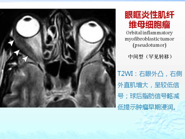 【PPT】头颈部软组织肿瘤的影像表现