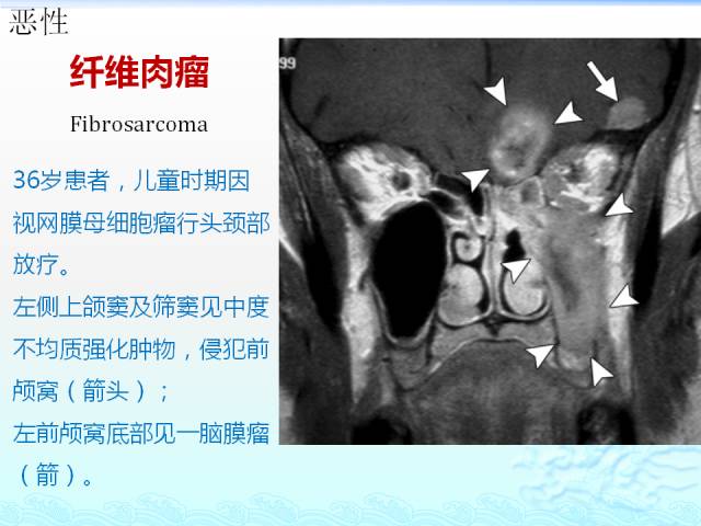 【PPT】头颈部软组织肿瘤的影像表现
