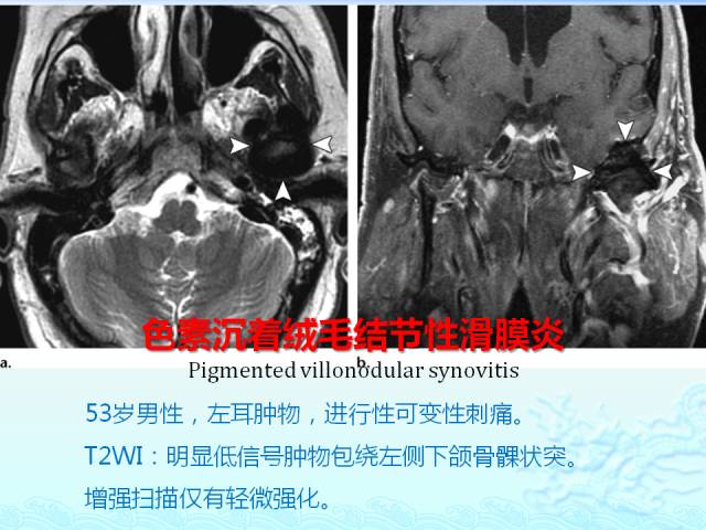 【PPT】头颈部软组织肿瘤的影像表现