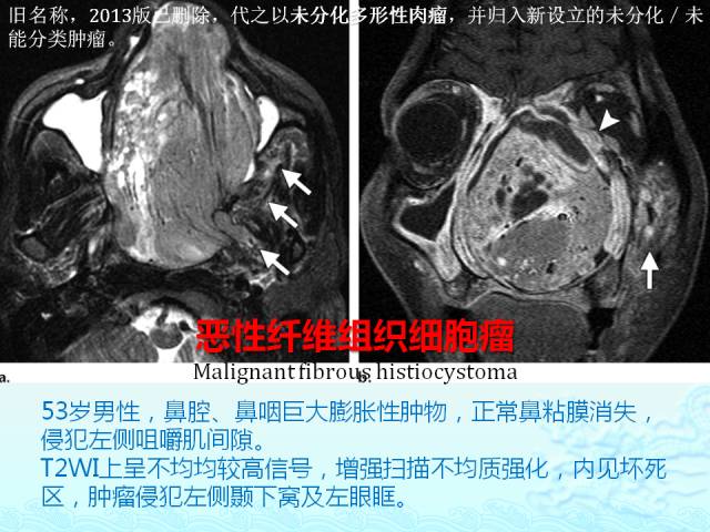 【PPT】头颈部软组织肿瘤的影像表现