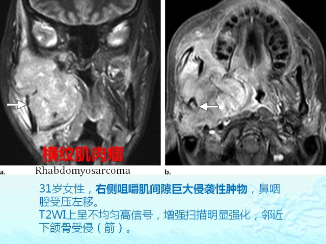 【PPT】头颈部软组织肿瘤的影像表现
