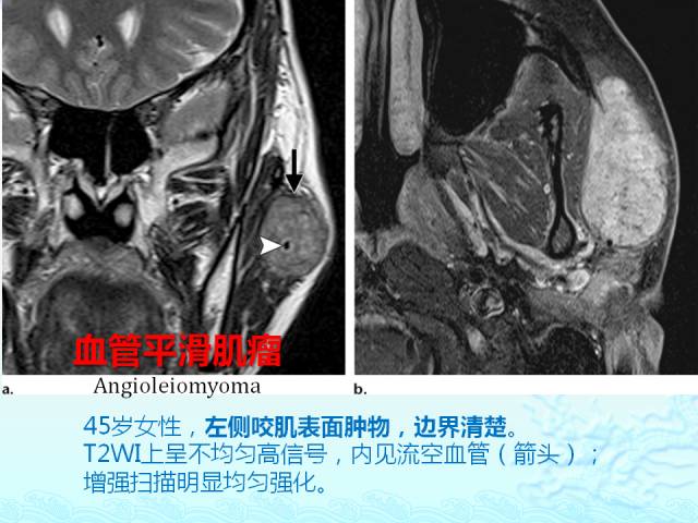 【PPT】头颈部软组织肿瘤的影像表现
