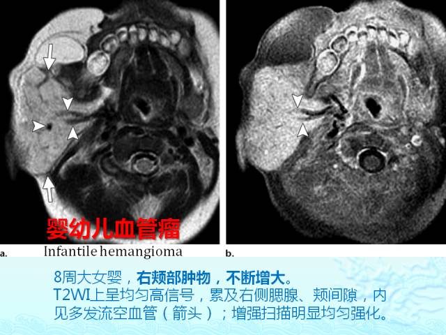 【PPT】头颈部软组织肿瘤的影像表现