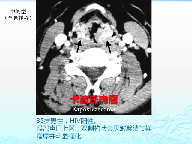 【PPT】头颈部软组织肿瘤的影像表现