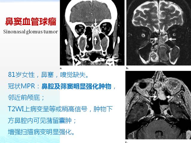 【PPT】头颈部软组织肿瘤的影像表现