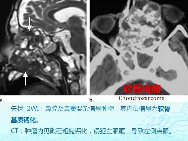 【PPT】头颈部软组织肿瘤的影像表现