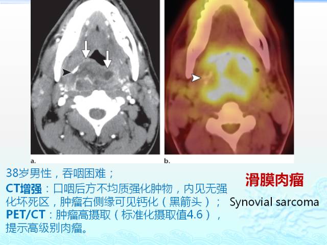 【PPT】头颈部软组织肿瘤的影像表现