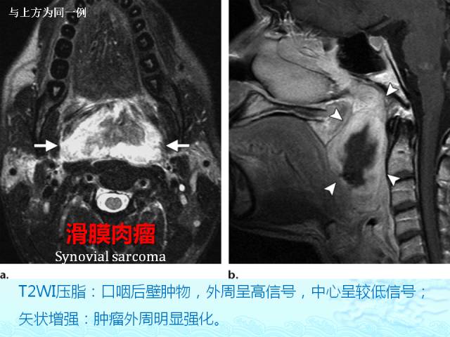 【PPT】头颈部软组织肿瘤的影像表现