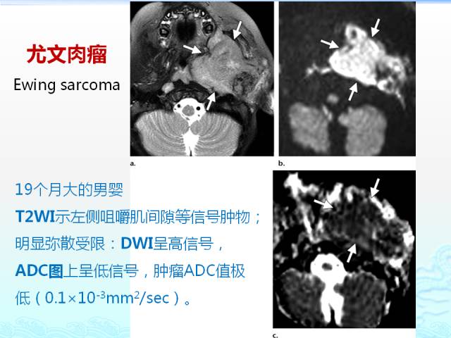【PPT】头颈部软组织肿瘤的影像表现