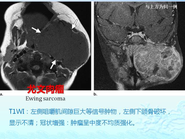 【PPT】头颈部软组织肿瘤的影像表现