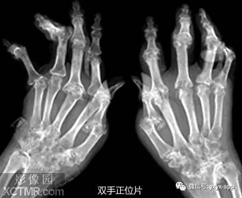 【病例】类风湿性关节炎1例X线影像诊断分析