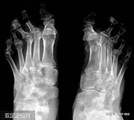 【病例】类风湿性关节炎1例X线影像诊断分析 【病例】类风湿性关节炎1例X线影像诊断分析