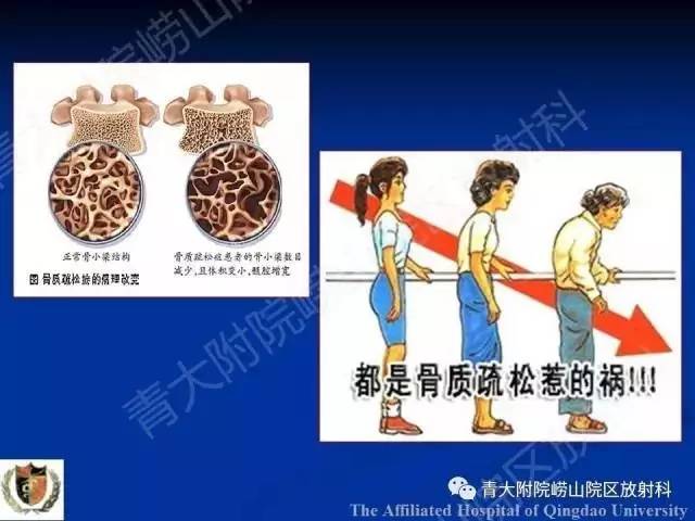 【PPT】骨关节基本病变