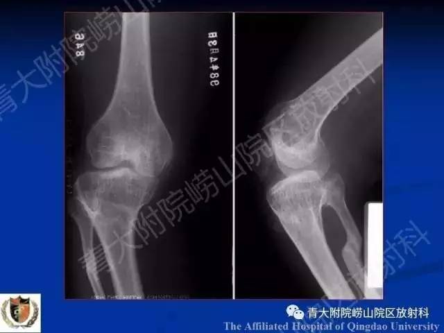 【PPT】骨关节基本病变