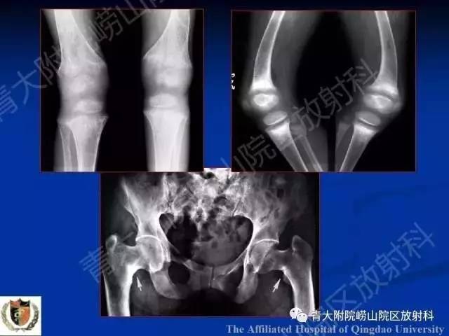 【PPT】骨关节基本病变