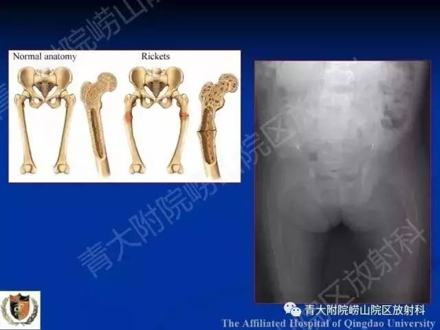 【PPT】骨关节基本病变