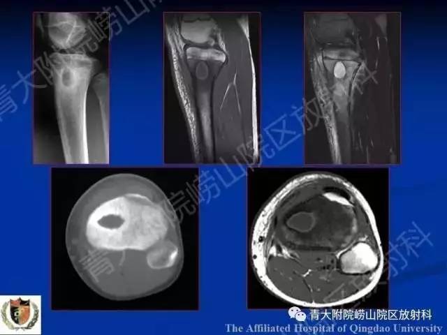 【PPT】骨关节基本病变