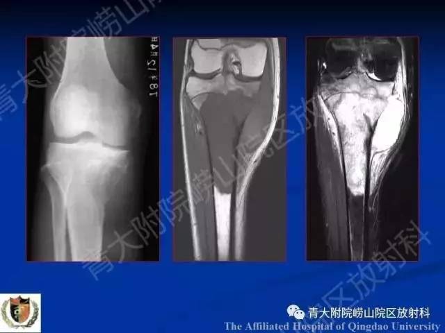 【PPT】骨关节基本病变