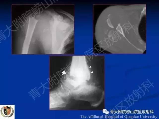 【PPT】骨关节基本病变