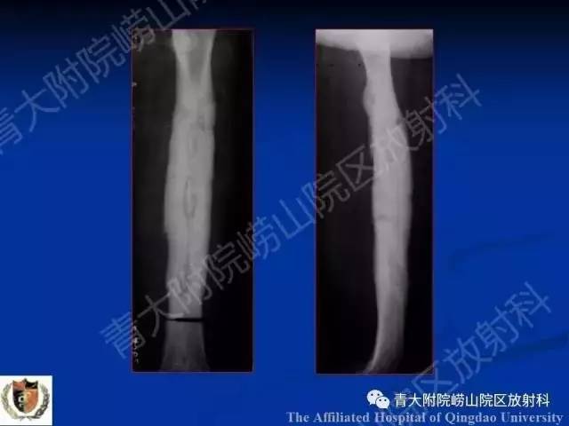【PPT】骨关节基本病变