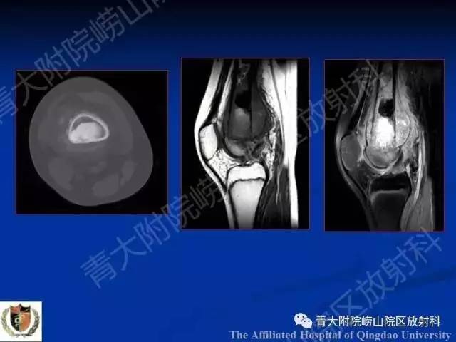 【PPT】骨关节基本病变