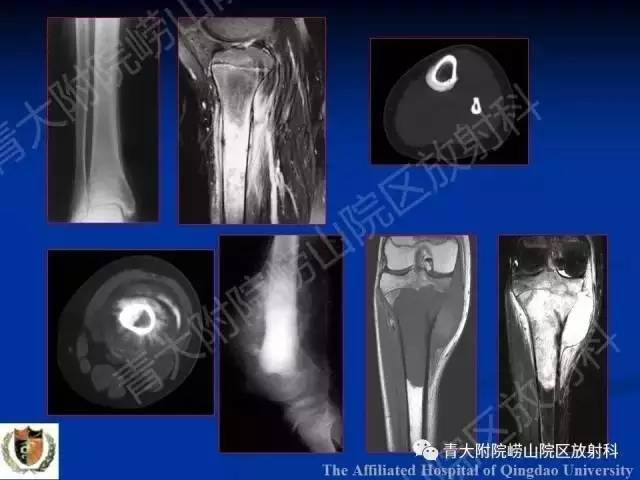 【PPT】骨关节基本病变