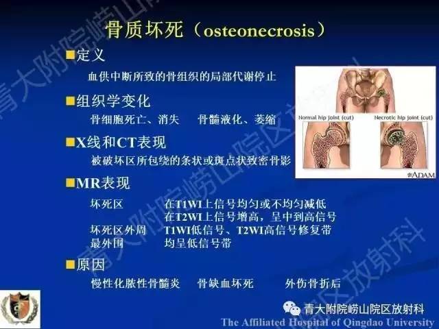 【PPT】骨关节基本病变