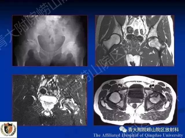 【PPT】骨关节基本病变