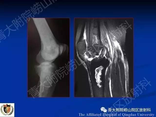 【PPT】骨关节基本病变