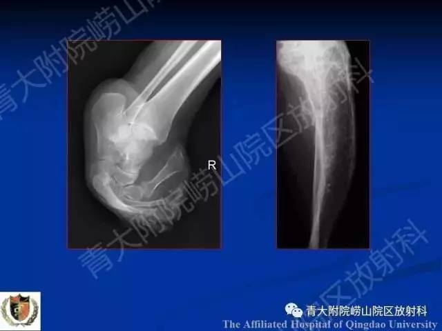 【PPT】骨关节基本病变
