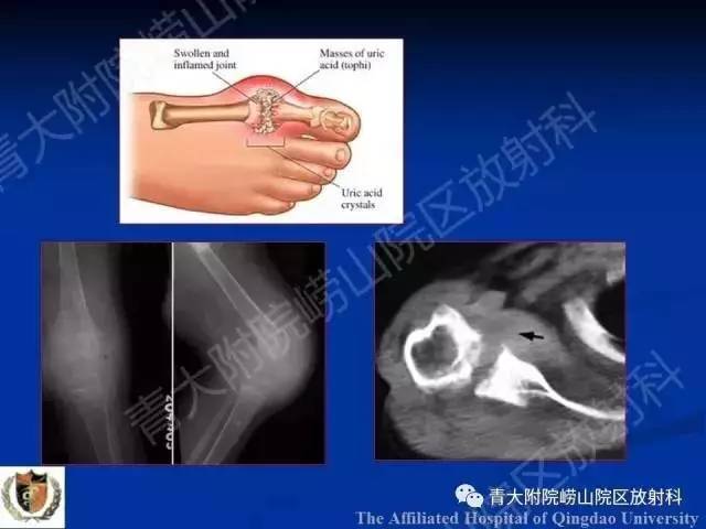 【PPT】骨关节基本病变