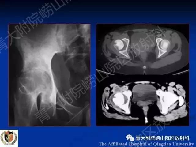 【PPT】骨关节基本病变