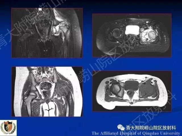 【PPT】骨关节基本病变