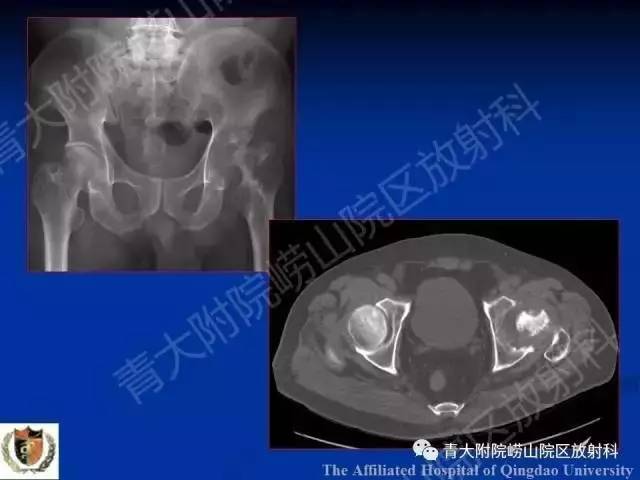 【PPT】骨关节基本病变