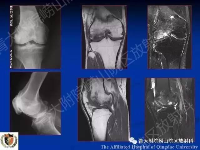 【PPT】骨关节基本病变