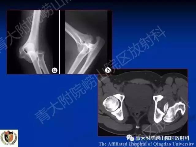 【PPT】骨关节基本病变