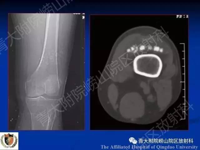【PPT】骨关节基本病变