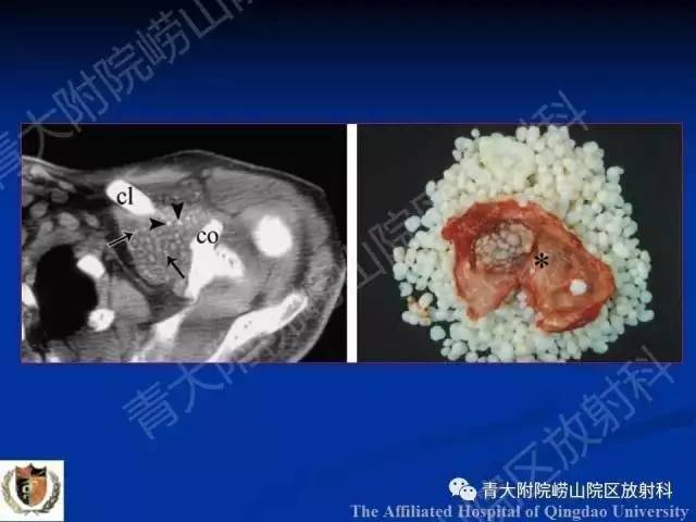【PPT】骨关节基本病变
