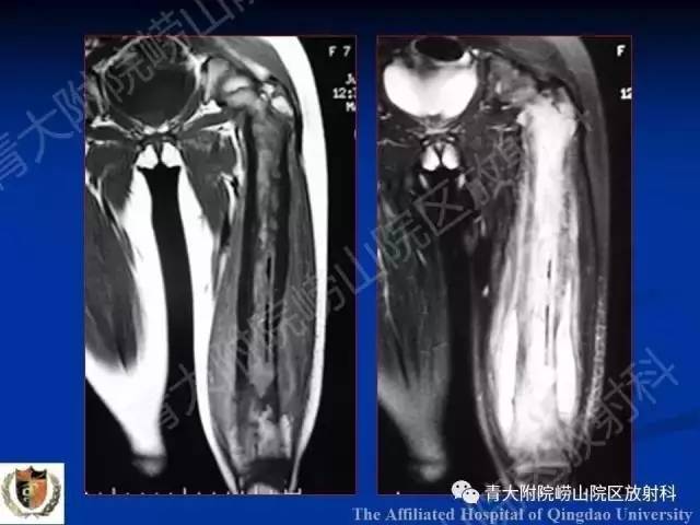 【PPT】骨关节基本病变