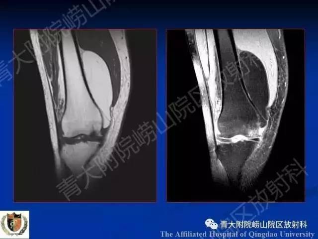 【PPT】骨关节基本病变