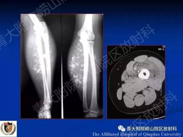 【PPT】骨关节基本病变