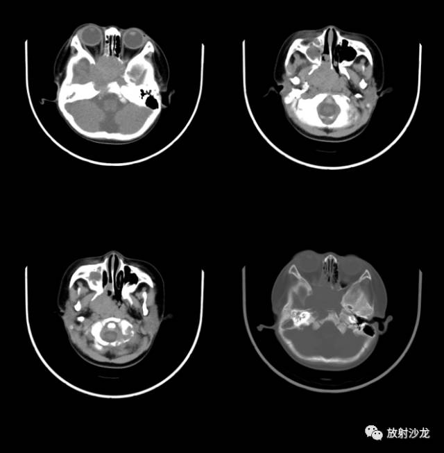【病例】鼻咽部朗格汉斯细胞组织细胞增生症1例