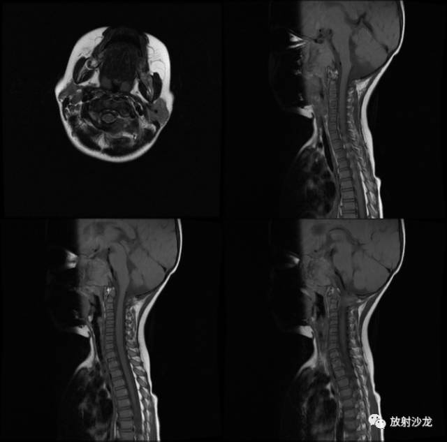 【病例】鼻咽部朗格汉斯细胞组织细胞增生症1例 【病例】鼻咽部朗格汉斯细胞组织细胞增生症1例