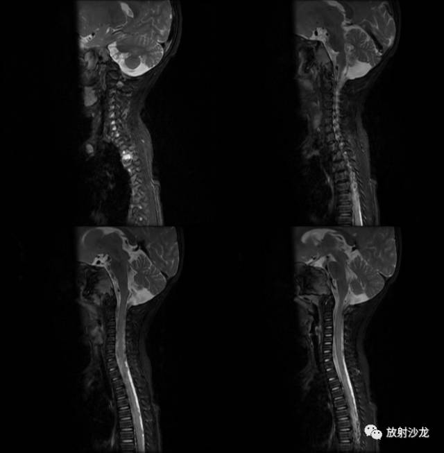 【病例】鼻咽部朗格汉斯细胞组织细胞增生症1例 【病例】鼻咽部朗格汉斯细胞组织细胞增生症1例
