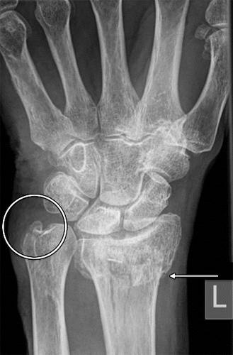 代谢性骨病的影像学表现:质疏松Osteoporosis 代谢性骨病的影像学表现:质疏松Osteoporosis