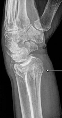 代谢性骨病的影像学表现:质疏松Osteoporosis 代谢性骨病的影像学表现:质疏松Osteoporosis
