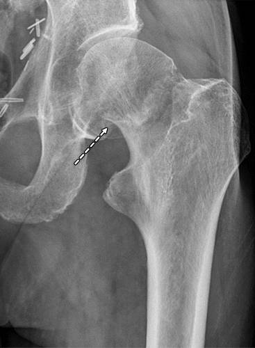 代谢性骨病的影像学表现:质疏松Osteoporosis 代谢性骨病的影像学表现:质疏松Osteoporosis