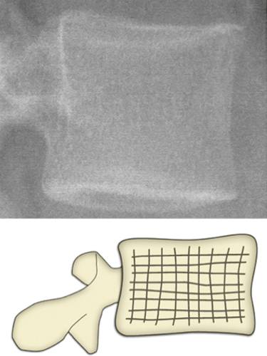 代谢性骨病的影像学表现:质疏松Osteoporosis 代谢性骨病的影像学表现:质疏松Osteoporosis