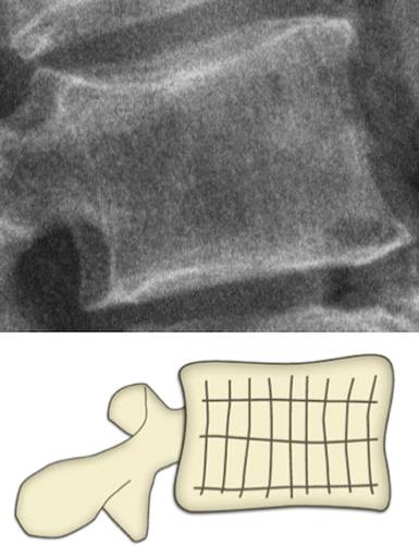 代谢性骨病的影像学表现:质疏松Osteoporosis 代谢性骨病的影像学表现:质疏松Osteoporosis