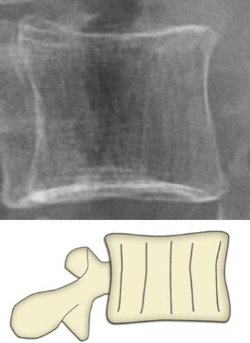 代谢性骨病的影像学表现：质疏松Osteoporosis